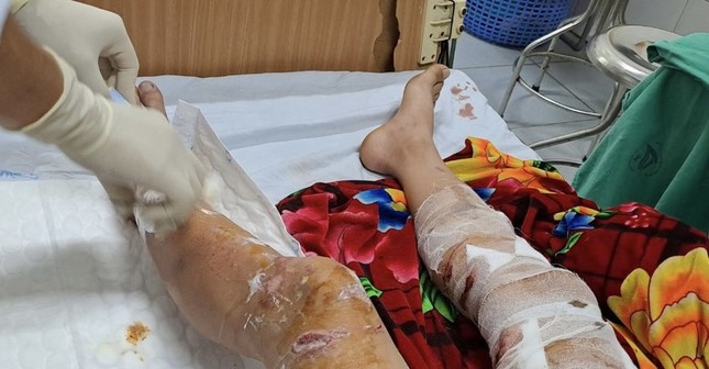 Lào Cai: Nam sinh bị chó thả rông cắn gây thương tích nặng ảnh 1