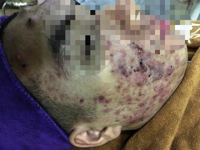 Quý bà Hà Nội mặt 'nát nhừ' vì lăn kim làm đẹp, tẩy trắng da ảnh 1