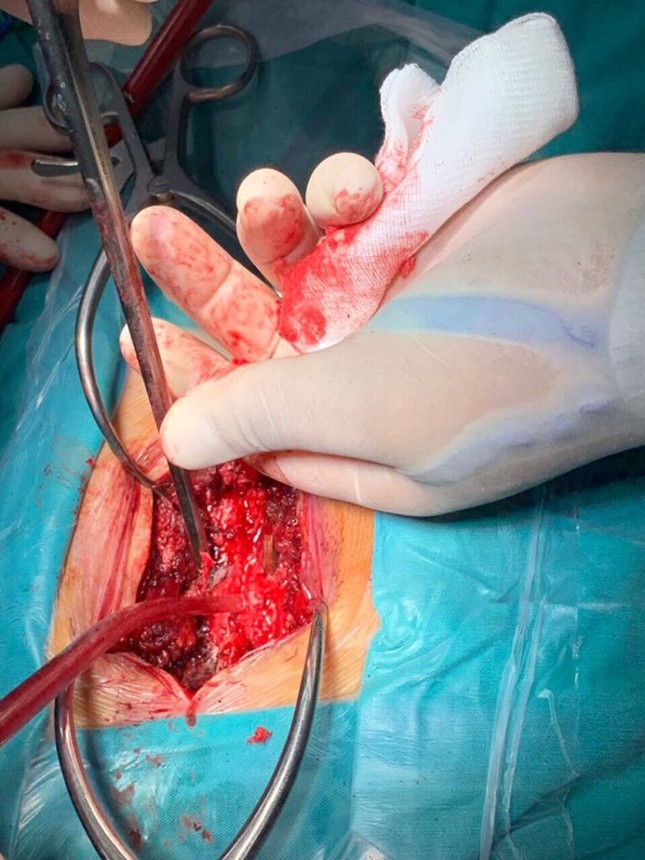 Mâu thuẫn khi ăn cưới, thanh niên dùng que xiên thịt đâm bạn thủng tủy sống ảnh 1