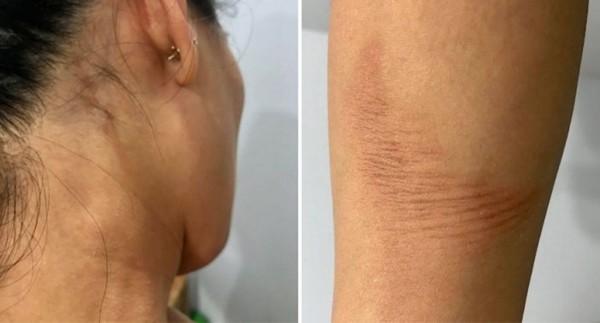 Đang nấu ăn thì nồi áp suất phát nổ: Một người mẹ bị bỏng nặng, em bé 2 tuổi thoát nạn ảnh 4