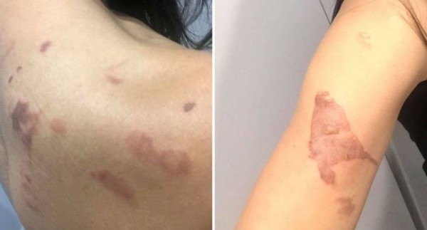 Đang nấu ăn thì nồi áp suất phát nổ: Một người mẹ bị bỏng nặng, em bé 2 tuổi thoát nạn ảnh 2