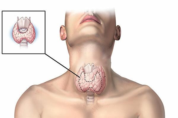 Dấu hiệu bất thường cảnh báo nguy cơ bị ung thư tuyến giáp, tuyệt đối không được bỏ qua ảnh 1