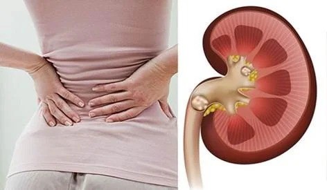 Thói quen tưởng vô hại nhưng lại là nguyên nhân khiến thận chứa cả ‘túi sỏi' ảnh 1