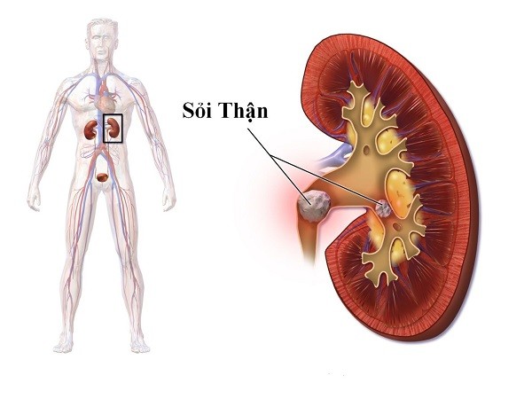 Thói quen tưởng vô hại nhưng lại là nguyên nhân khiến thận chứa cả ‘túi sỏi' ảnh 2