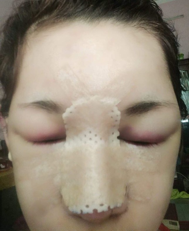 Chia tay vì bị chê bai ngoại hình, cô gái 21 tuổi “lột xác” nhờ phẫu thuật thẩm mỹ ảnh 2