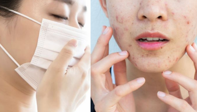 Đeo khẩu trang khiến mặt nhiều mụn hơn, phải giải quyết sao đây? ảnh 1