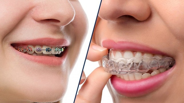 “Không thể để răng xấu suốt kiếp" - niềng răng không phiền phức như bạn tưởng! ảnh 1