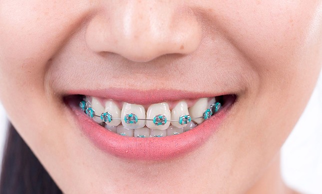 “Không thể để răng xấu suốt kiếp" - niềng răng không phiền phức như bạn tưởng! ảnh 3