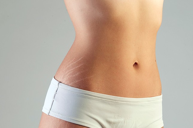 Rạn da tuổi dậy thì: Rắc rối ngoại hình khó nói thành lời của con gái ảnh 1