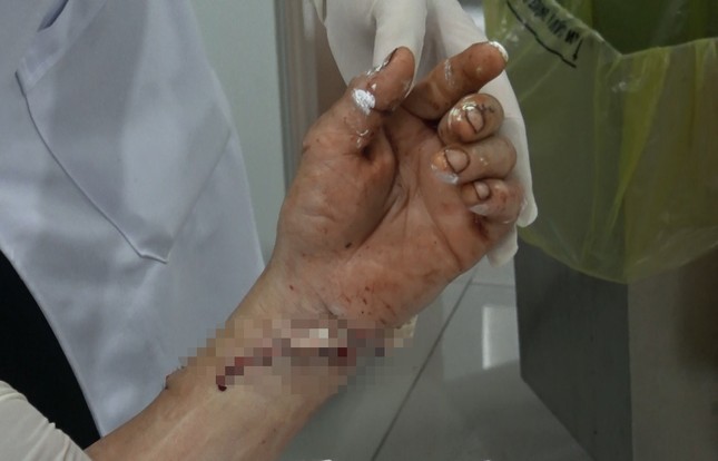 Nam thanh niên bị chém gần đứt lìa bàn tay được phẫu thuật nối thành công ảnh 1