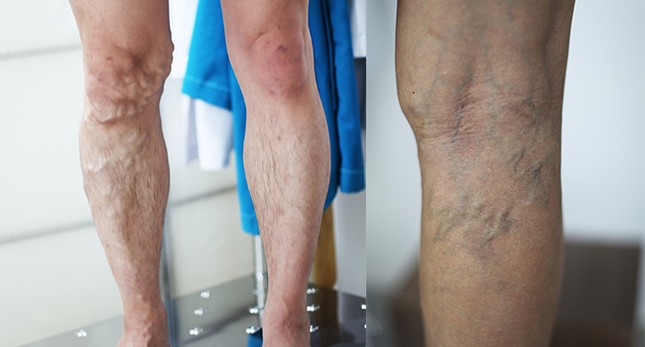 Bà lão bị gà mổ chết và sự nguy hiểm của bệnh giãn tĩnh mạch ảnh 1