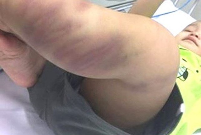 Những vụ bạo hành trẻ em gây chấn động dư luận gần đây ảnh 4