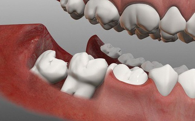 Đau răng khôn: Những điều quan trọng bạn cần biết ảnh 10