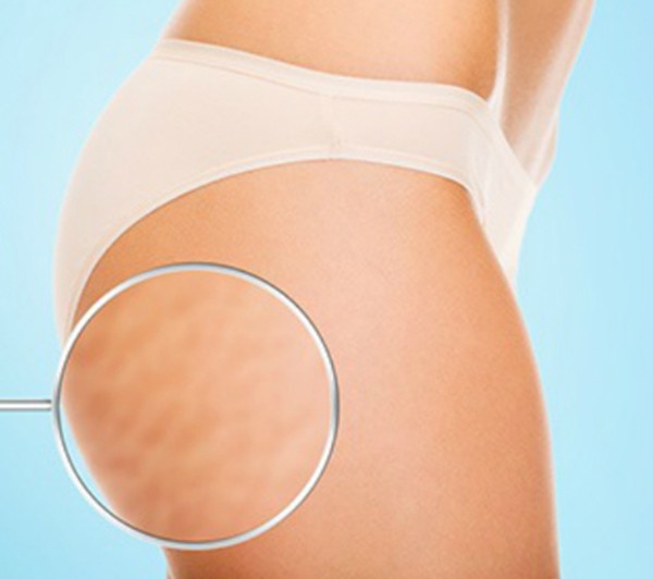 Vết rạn xấu xí ở da tuổi dậy thì, phải làm sao? ảnh 1