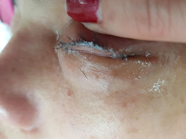 Cô gái bị dính mắt sau khi đi nối lông mi ảnh 1