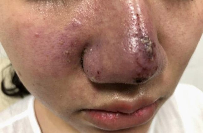Hỏng mí, mù mắt vì làm đẹp ở spa chui ảnh 2
