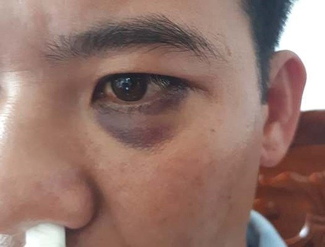 Học sinh dẫn người lạ vào trường đánh thầy giáo gãy xương mũi ảnh 3