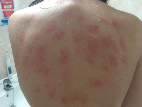 Căn bệnh siêu hiếm khiến cô gái trẻ dị ứng với cả nước mắt của chính mình ảnh 2