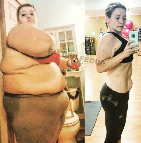 Giảm ngoạn mục 141 kg trong 2 năm, cô gái cắt bỏ tới 3 kg da thừa ảnh 1