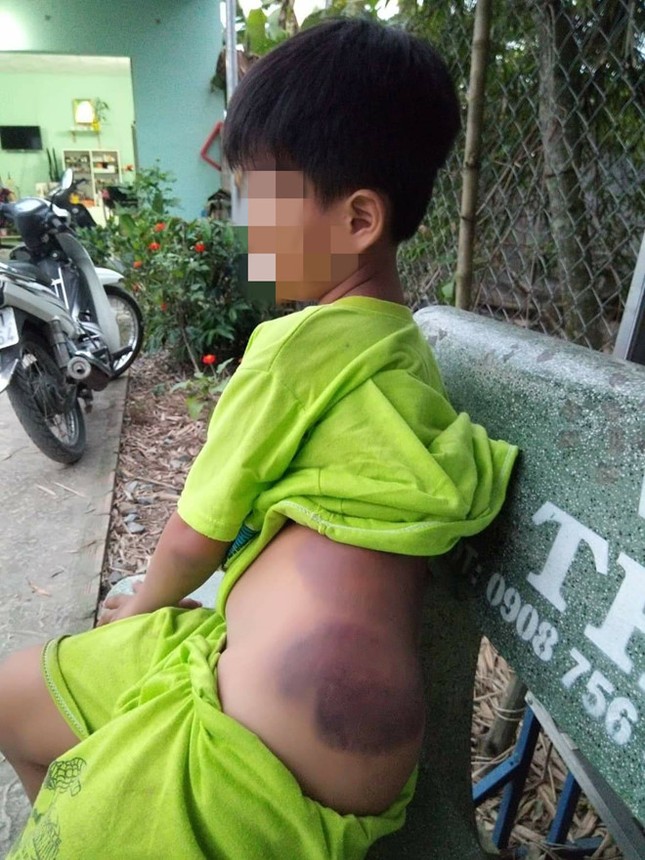 Bộ GD&ĐT yêu cầu báo cáo khẩn vụ học sinh lớp 1 nghi bị cô giáo đánh ảnh 2