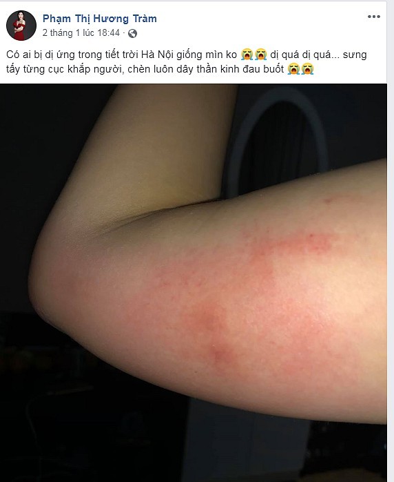 Hương Tràm bị dị ứng cấp tính, nổi đỏ khắp người trước thềm liveshow đầu tiên trong sự nghiệp ảnh 3