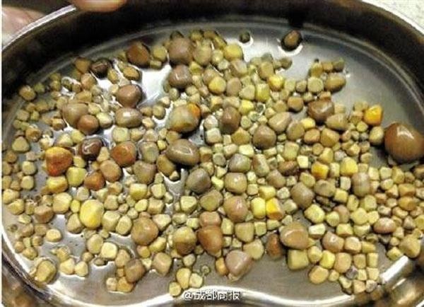 Người phụ nữ có hơn 2000 viên sỏi mật chỉ vì thói quen hàng triệu người cũng đang mắc phải ảnh 2
