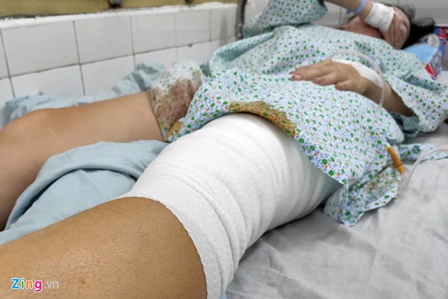 Nữ cổ động viên kể khoảnh khắc bị thương do pháo sáng ở Hàng Đẫy ảnh 1