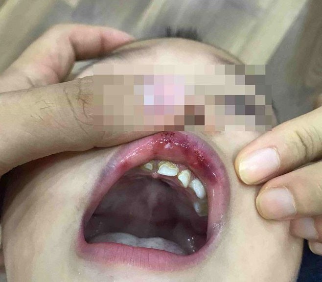 Điểm nhấn giáo dục: Cô giáo ở Hà Nội tát trẻ bầm dập, tụ máu môi