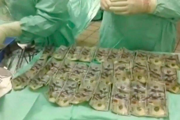 Số tiền mệnh giá 100 USD lấy từ dạ dày và ruột của nữ bệnh nhân Colombia.