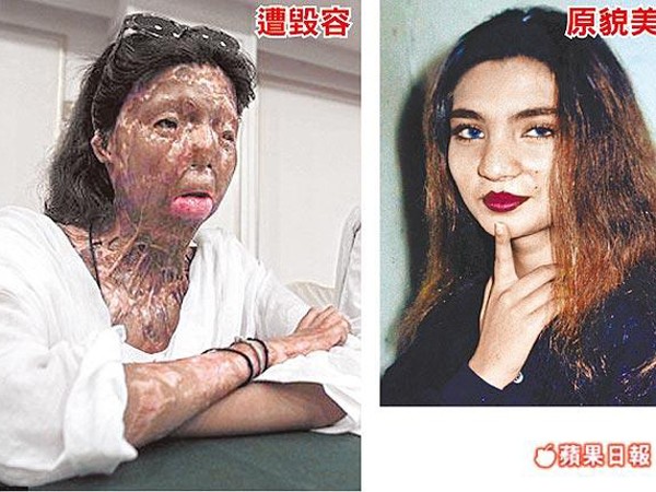 Fakhra trước và sau khi bị chồng tạt a-xít