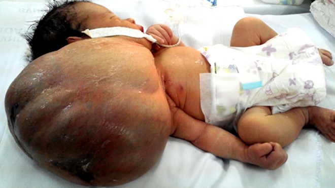 Các bác sĩ phải mổ để đưa bé ra khỏi cơ thể mẹ vì khối bướu quá to. Ảnh: Thành Nguyễn