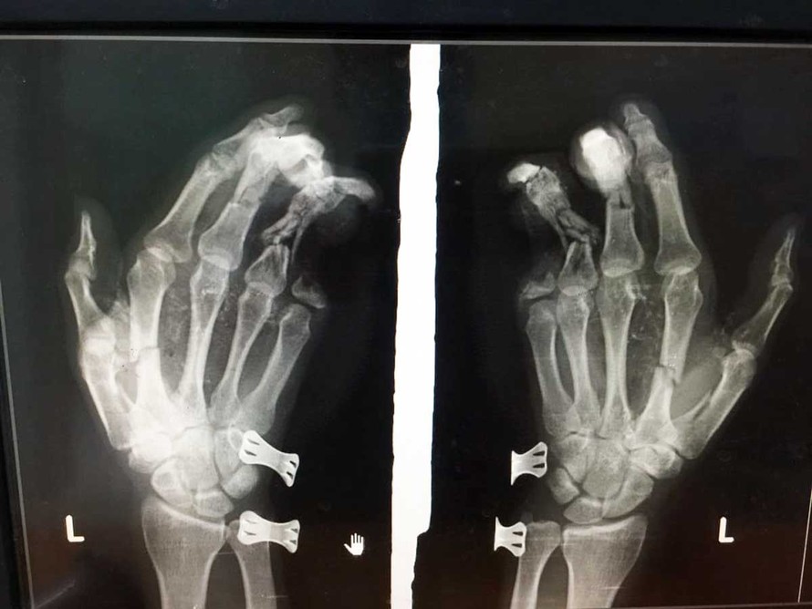  Phim chụp X-quang cho thấy ngón út của bệnh nhân bị mất 2 đốt.