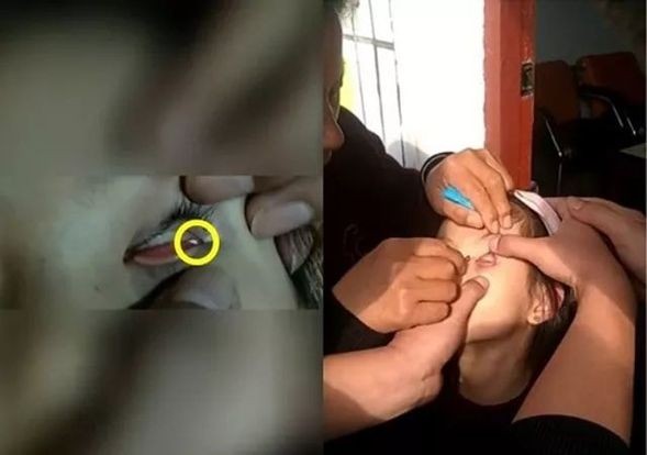 Trung Quốc: Bé gái suýt mù vì bị nhét giấy vào mắt