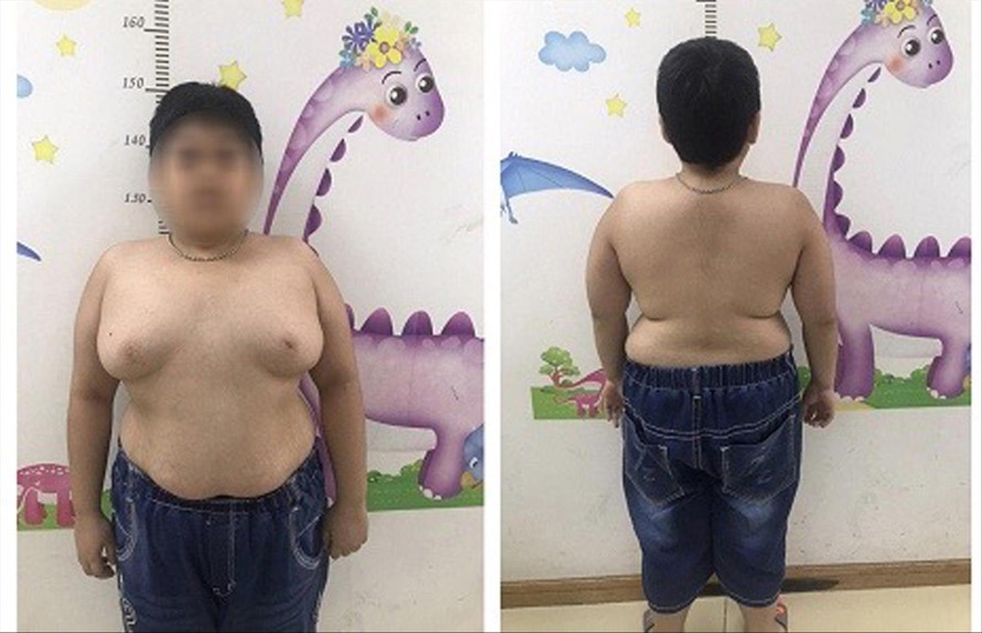 Bé trai 13 tuổi tăng cân mất kiểm soát sau khi lạm dụng thuốc corticoid Ảnh: T.Hà 