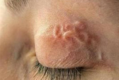Ấu trùng ký sinh di chuyển dưới mí mắt trên khi ăn thịt chó.
