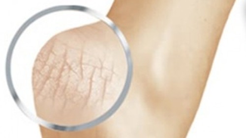 Làm sao để chân không bị nứt gót mùa đông?