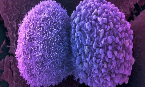 Tế bào miễn dịch bị biến đổi gene có thể tấn công và phá hủy tế bào ung thư. Ảnh: Anne Weston.