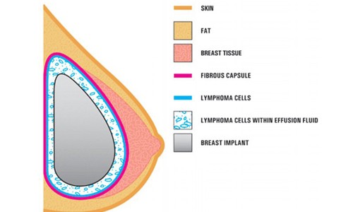 Xu hướng ung thư tăng do nâng ngực