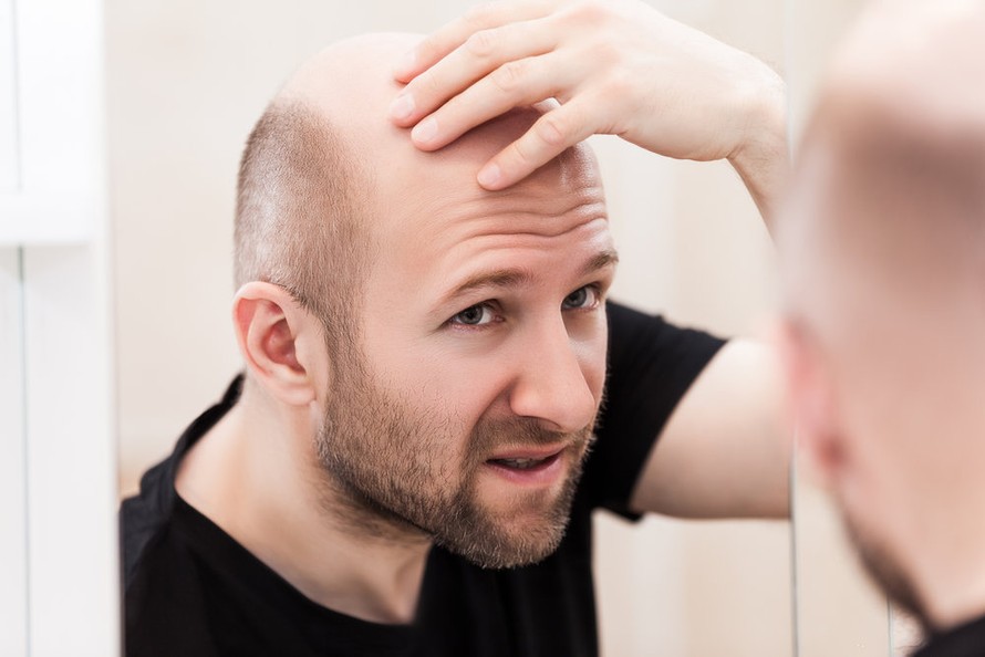 Rụng tóc nam giới Nguyên nhân và cách điều trị phòng ngừa
