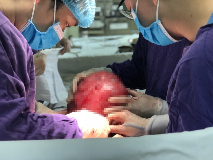 Các bác sĩ BV Ung bướu Hà Nội phẫu thuật cho bệnh nhân mang khối bướu khổng lồ. Ảnh: BV cung cấp