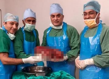 Các bác sĩ chụp ảnh cùng quả tận nặng 7,4kg. Ảnh: Bệnh viện Sir Ganga Ram