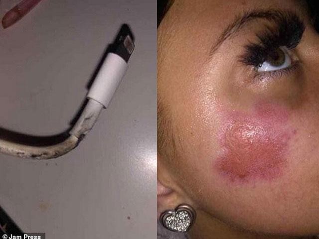 Thiếu nữ bị bỏng mặt vì iPhone bất ngờ phát nổ khi cắm sạc qua đêm