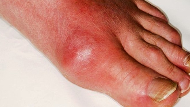 Khớp ngón chân cái là vị trí thường gặp nhất trong cơn gút cấp.