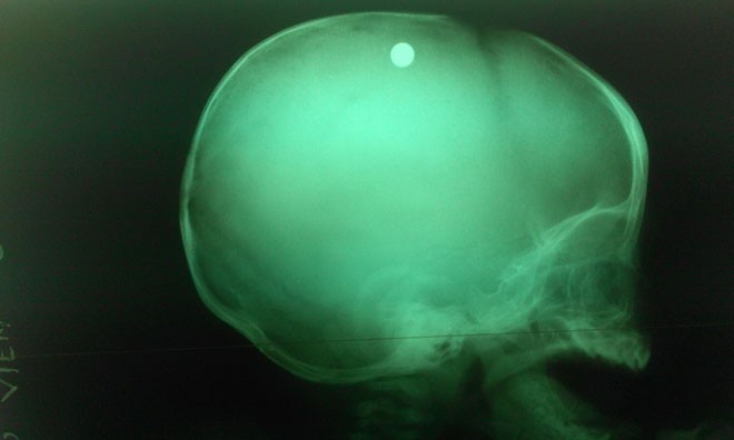 Viên đạn trong đầu bé trai 6 tuổi qua chụp X-quang- ảnh BV nhi đồng 2. 
