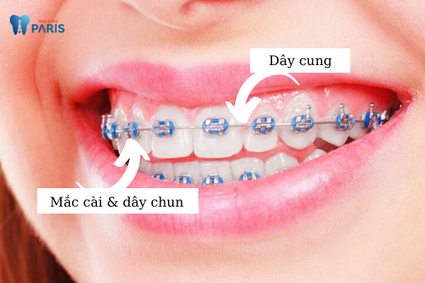 Nên lựa chọn niềng răng mắc cài kim loại thường hay tự buộc?