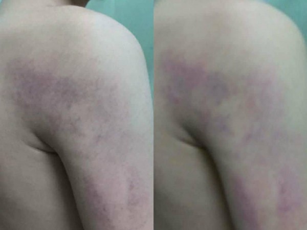 Hà Nội: Phụ huynh tố giáo viên đánh học sinh lớp 1 thâm tím