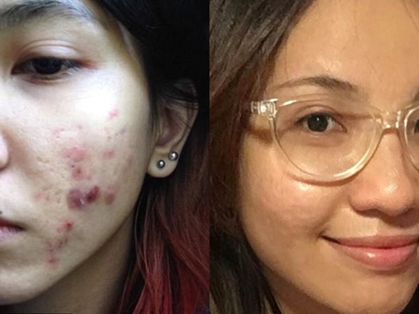 Khám phá phương pháp trị mụn "thần thánh" của một cô nàng 24 tuổi