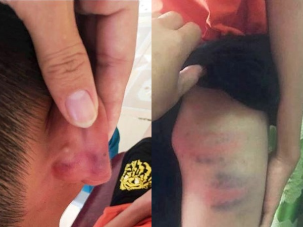Nghệ An: Nam sinh lớp 6 người đầy thương tích, nghi bị mẹ kế bạo hành