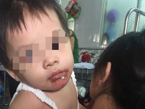 Người mẹ "tố" bảo mẫu đổ nước sôi bỏng miệng con gái 18 tháng tuổi