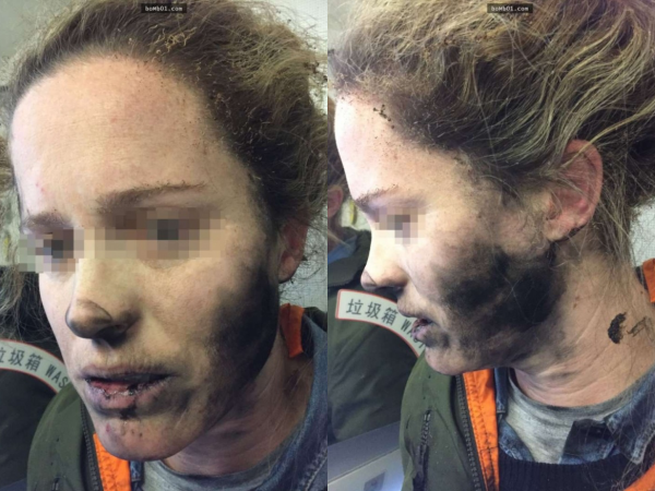 Câu chuyện cảnh giác: Đeo tai nghe khi đi máy bay khiến cô gái bị cháy tóc, bỏng mặt
